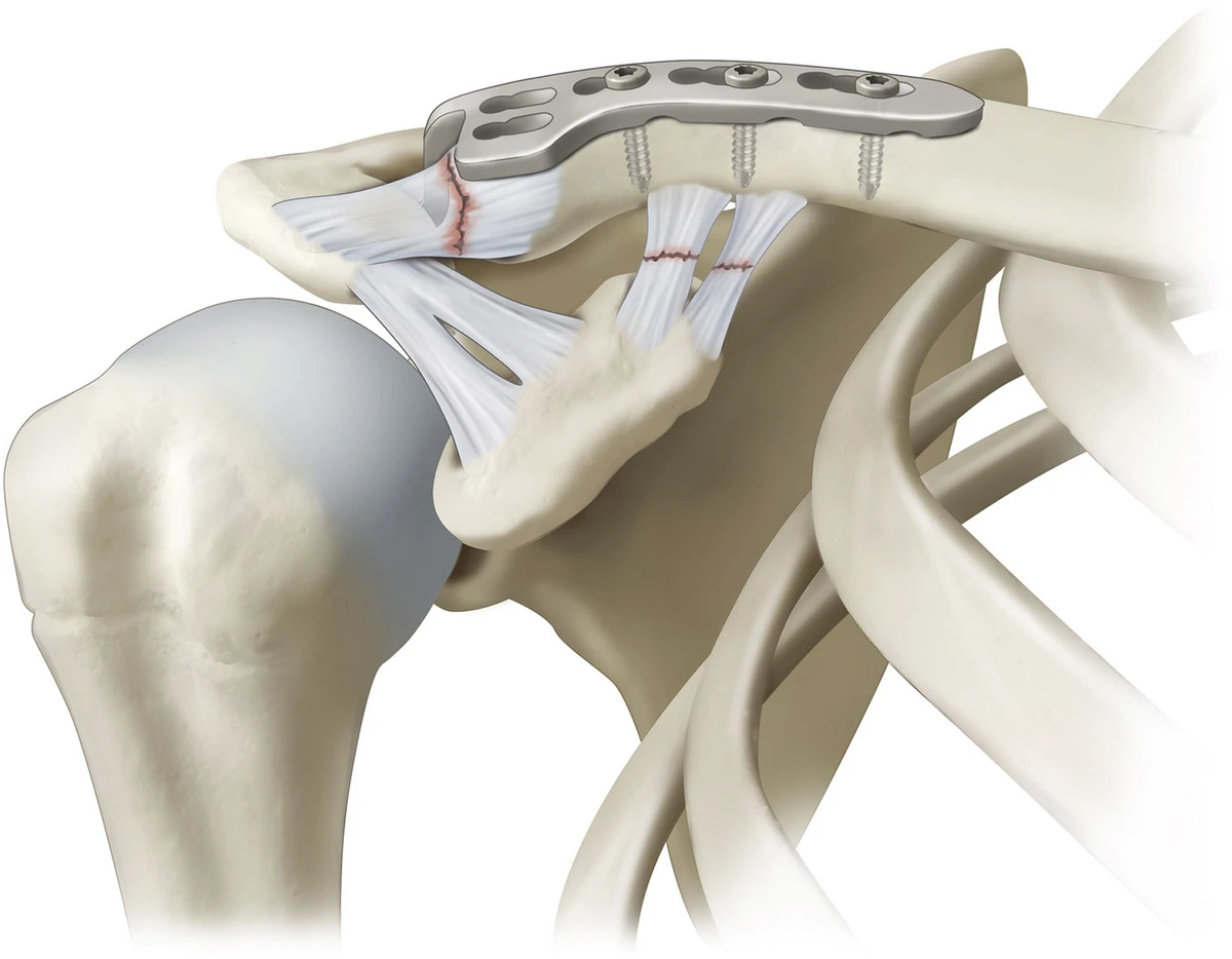 Luxação Acromioclavicular – o que é?