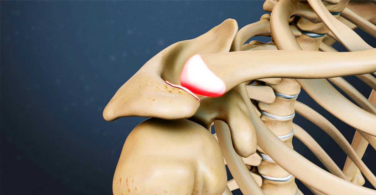Luxação acromioclavicular: Quando indicar o tratamento cirúrgico ou clínico?